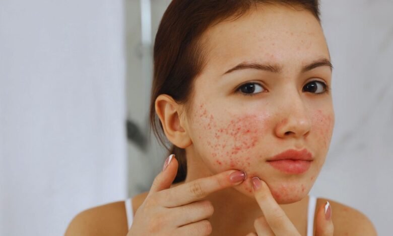 Beyond-Breakouts-Could-Your-Acne-Be-a-Hidden-Health-Threat